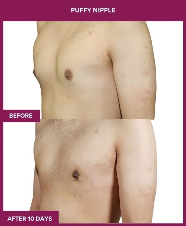 3 PUFFY NIPPLE (8)_68_