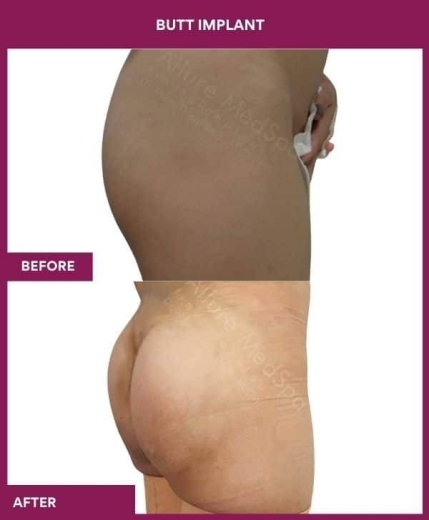 4 BUTT IMPLANT in Mumbai, India