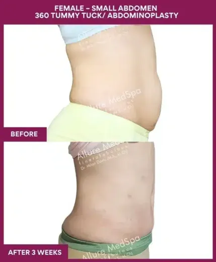 4 FEMALE – SMALL ABDOMEN 360 TUMMY TUCK_ ABDOMINOPLASTY (3)_11
