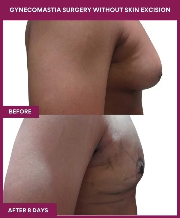 4Gynecomastia Surgery without Skin excision (2)_51_