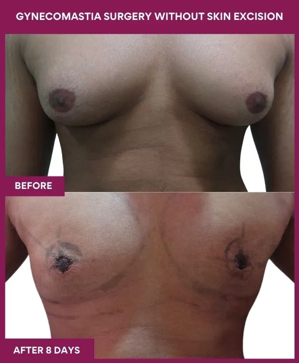 4Gynecomastia Surgery without Skin excision (4)_51_