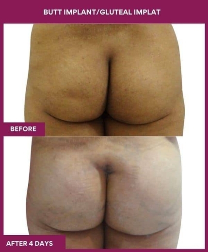 5 BUTT IMPLANT_GLUTEAL IMPLAT in Mumbai, India