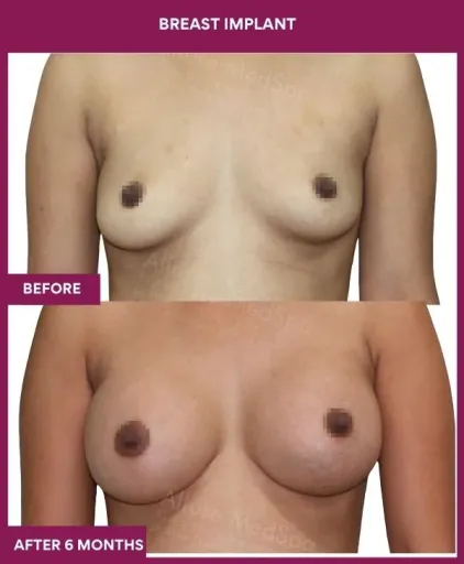 5 Breast implant_14_ (1)