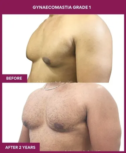5- GYNAECOMASTIA GRADE 1 (2)_