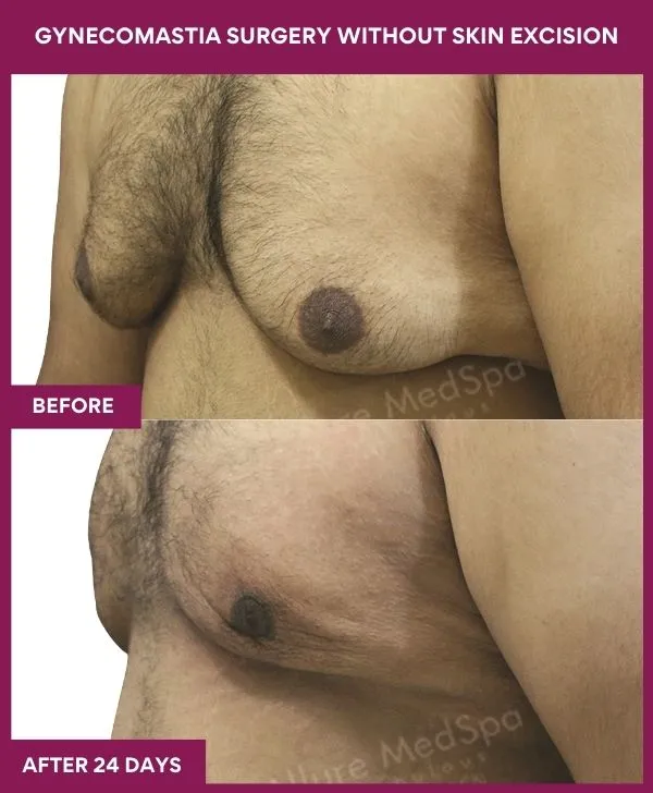 5 Gynecomastia Surgery without Skin excision_56_ (2)