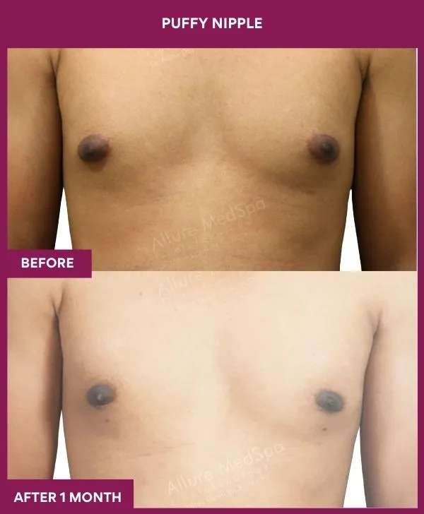 5 PUFFY NIPPLE (4)_64_