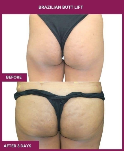 6 Brazilian Butt Lift (3) in Mumbai, India