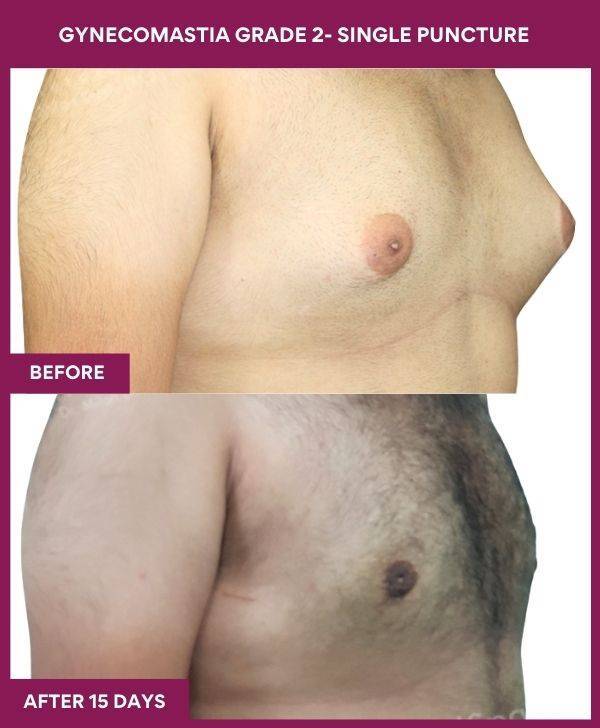 6-GYNAECOMASTIA GRADE 2-SINGLE PUNCTURE (2)