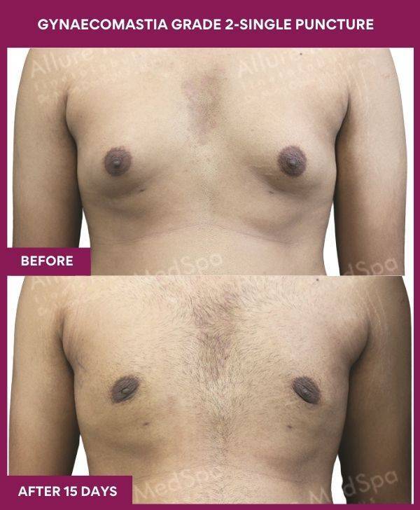 6-GYNAECOMASTIA GRADE 2-SINGLE PUNCTURE