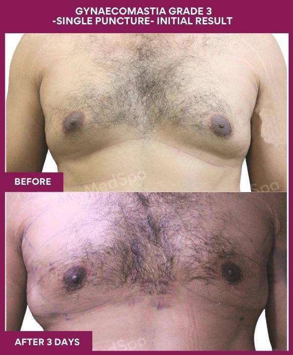 6-GYNAECOMASTIA GRADE 3 -SINGLE PUNCTURE- INITIAL RESULT (1)