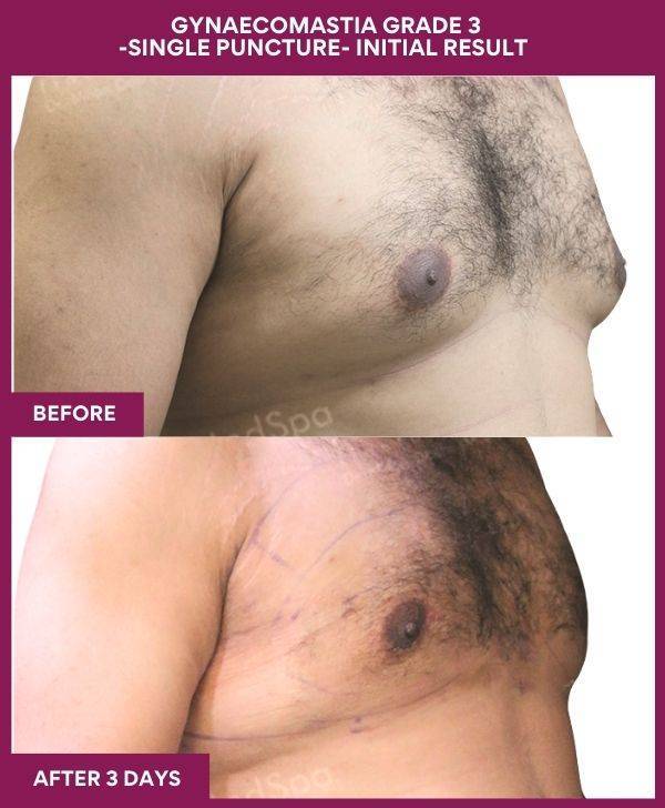 6-GYNAECOMASTIA GRADE 3 -SINGLE PUNCTURE- INITIAL RESULT (2)