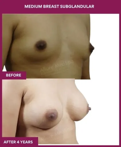 6 Medium breast subglandular (2)_15_
