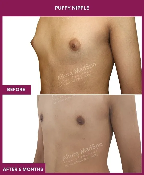 6 PUFFY NIPPLE (10)_72_