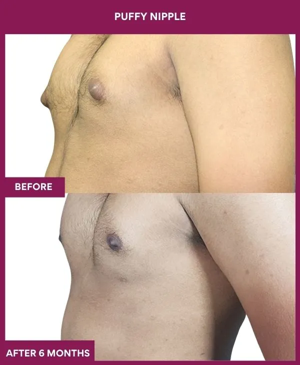 6 PUFFY NIPPLE (11)_72_