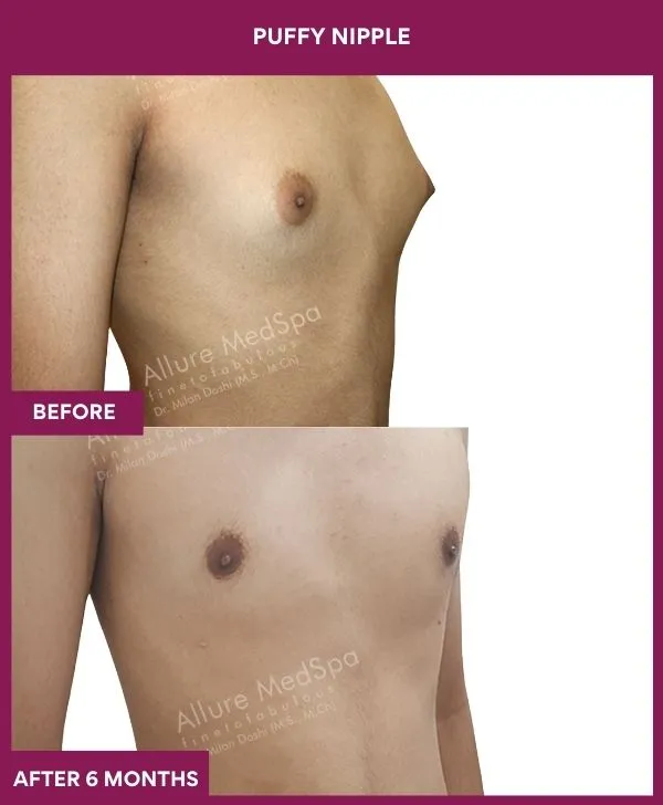 6 PUFFY NIPPLE (12)_72_