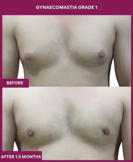 GYNAECOMASTIA GRADE 1 Surgery in Mumbai, India