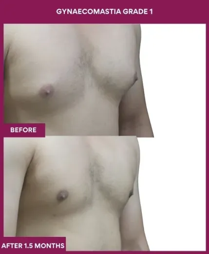GYNAECOMASTIA GRADE 1 Surgery in Mumbai, India