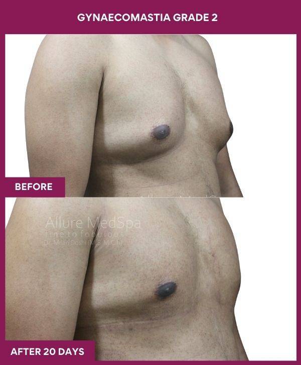 7-GYNAECOMASTIA GRADE 2 (2)