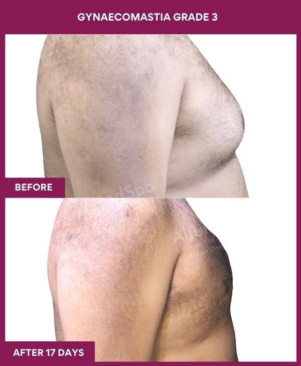 7-GYNAECOMASTIA GRADE 3 (2)
