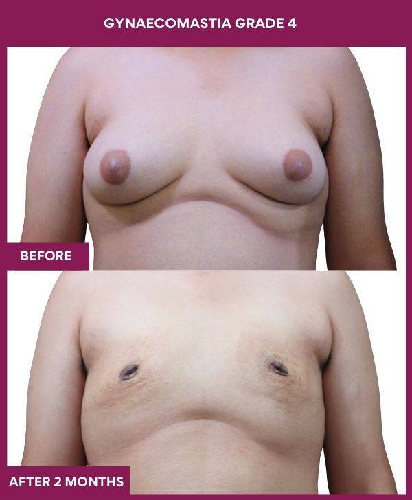 7- GYNAECOMASTIA GRADE 4 (2)