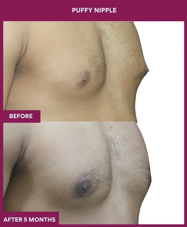 PUFFY NIPPLE in Mumbai, India