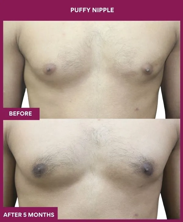 PUFFY NIPPLE in Mumbai, India