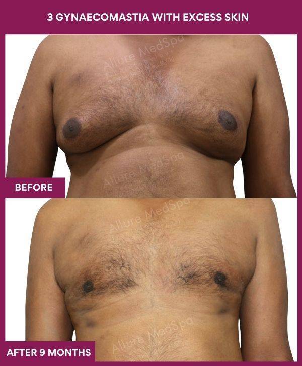 8-3 gynaecomastia with excess skin (1)