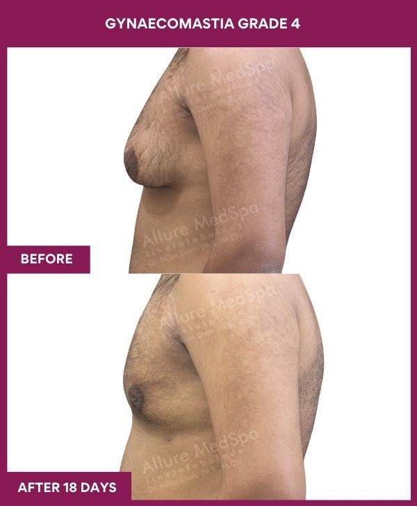 8 - GYNAECOMASTIA GRADE 4 (2)