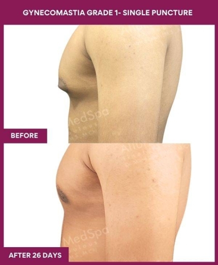 8- Gynecomastia grade 1- Single Puncture (3)