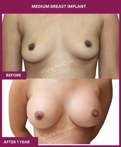 8 MEDIUM BREAST IMPLANT_23_ (1)