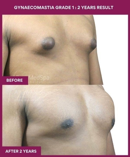 9-GYNAECOMASTIA GRADE 1 _ 2 years result (2)