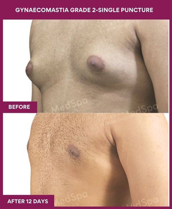 9-GYNAECOMASTIA GRADE 2-SINGLE PUNCTURE (3)
