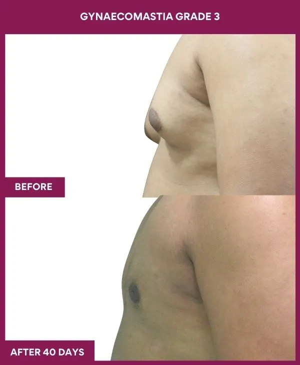 GYNAECOMASTIA GRADE 3 Surgery in Mumbai, India
