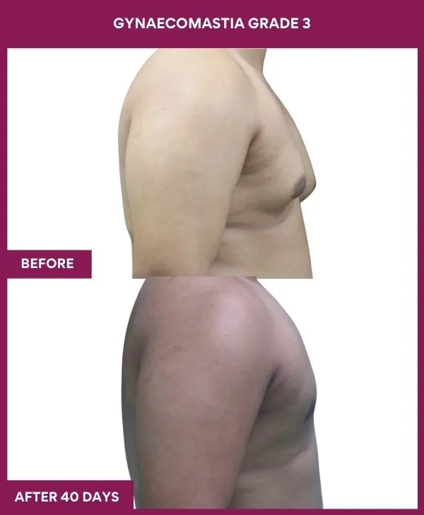 GYNAECOMASTIA GRADE 3 Surgery in Mumbai, India