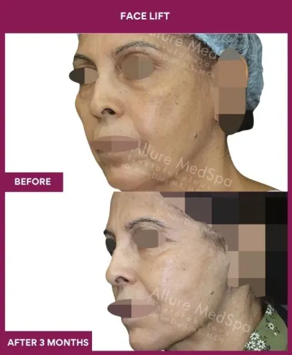 10 FACE LIFT (3)_22_