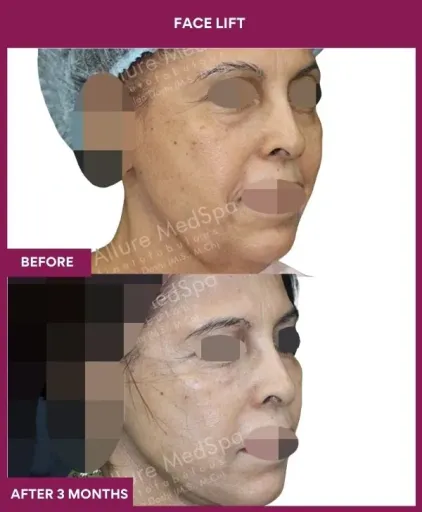 10 FACE LIFT (5)_22_