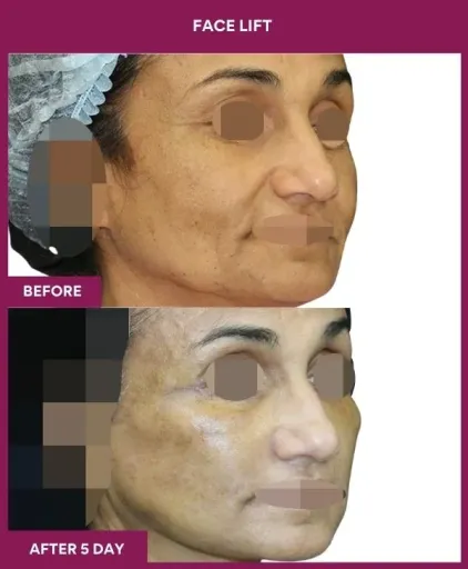 11 FACE LIFT (3)_25_