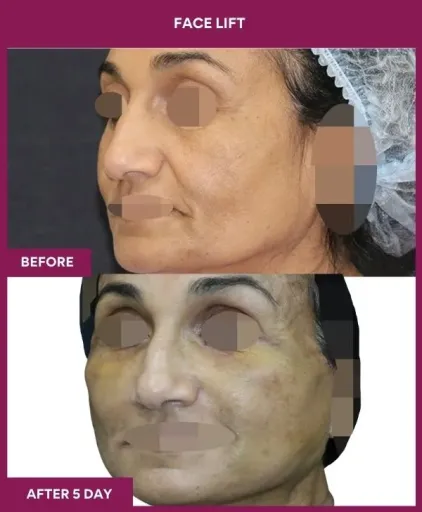 11 FACE LIFT (5)_25_