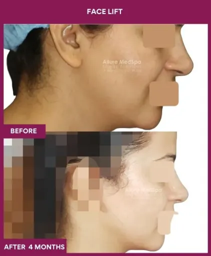 12 FACE LIFT_29_ (3)