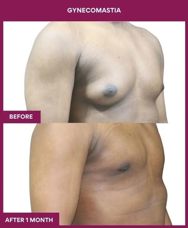 ASYMETRIC GYNECOMASTIA in Mumbai, India