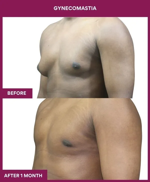 ASYMETRIC GYNECOMASTIA in Mumbai, India