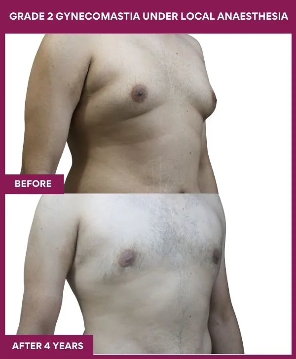 GRADE 2 GYNECOMASTIA UNDER LOCAL ANAESTHESIA in Mumbai, India