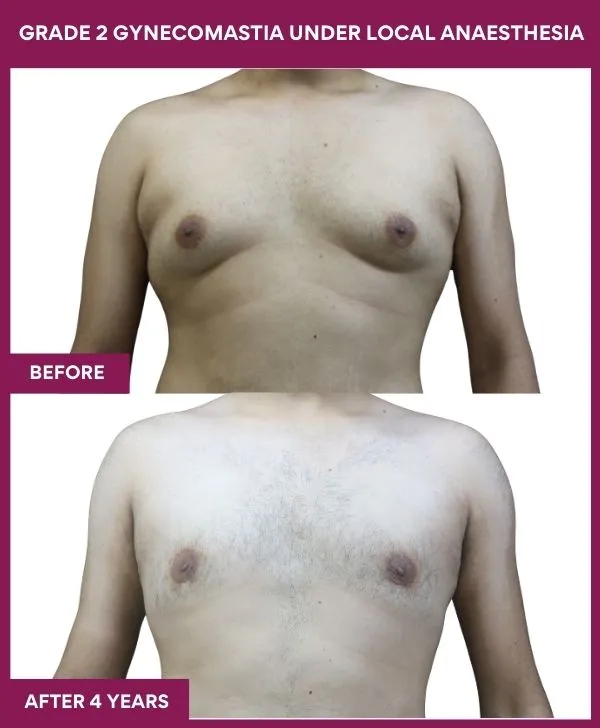 GRADE 2 GYNECOMASTIA UNDER LOCAL ANAESTHESIA in Mumbai, India