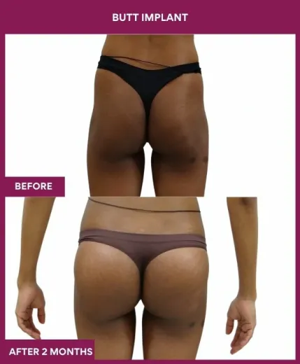 1 BUTT implant