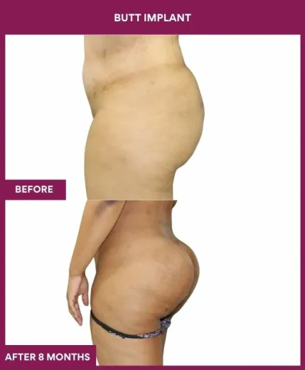 3 BUTT implant (2)