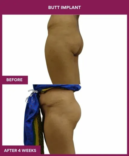 4 BUTT implant (3)