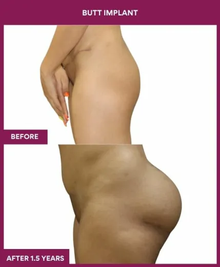 7 BUTT implant (2)