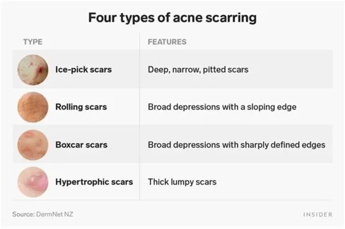 Four Types of Acne Scarring in Mumbai, India