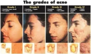The Grades of Acne in Mumbai, India