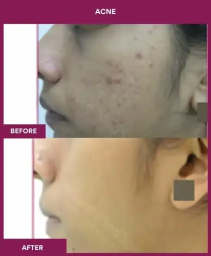 1 Acne Treatment (3)